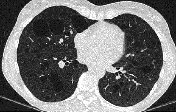 Axial HRCT image showing multiple bilateral, thin-walled pulmonary cysts with upper-lobe predominance. Several cysts abut the pleural surface, which is consistent with sites predisposing to recurrent spontaneous pneumothorax