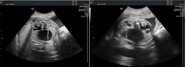 Prenatal ultrasonographic images demonstrate bilateral fetal hydronephrosis secondary to compression of the urinary tract by the pelvic component of the sacrococcygeal teratoma.
