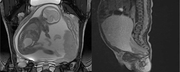 Fetal and postnatal magnetic resonance images demonstrate a sacrococcygeal mass with both external and intrapelvic components. The lesion extends anteriorly toward the posterior aspect of the bladder, supporting the diagnosis of an Altman type III sacrococcygeal teratoma.

