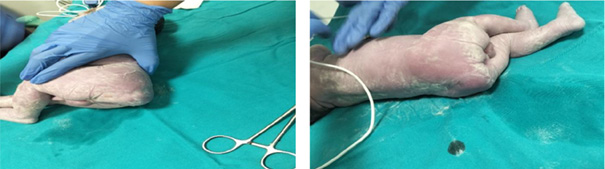 Intraoperative photographs taken during cesarean delivery show the newborn with an externally visible sacrococcygeal mass protruding from the sacral region.
