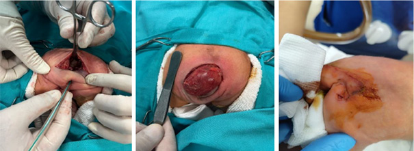 Intraoperative photographs show the surgical excision of the sacrococcygeal teratoma, including exposure and removal of the sacrococcygeal component of the mass.
