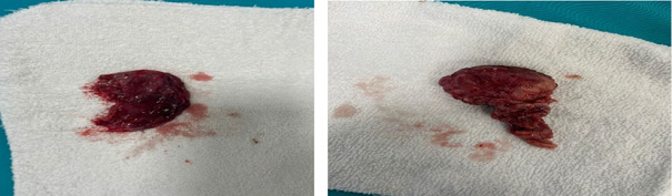 Intraoperative photograph shows the excised sacrococcygeal teratoma specimen after surgical removal.
