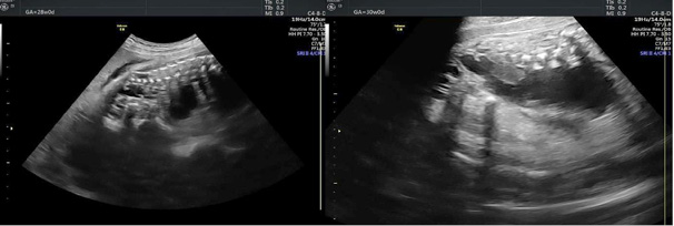 Prenatal sagittal ultrasonographic images show a sacrococcygeal mass with predominantly cystic components and minimal solid areas. The lesion extends from the fetal sacrococcygeal region toward the pelvis and abdomen, which is consistent with an Altman type III sacrococcygeal teratoma.
