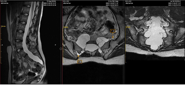 [Three T2-weighted spine MRI images are shown from left to right: sagittal, axial Cube, and 3D FIESTA sequences. Together, the images demonstrate dural ectasia, with ballooning and widening of the dural sac in the thoracic, lumbar, and sacral regions of the spine. In the sagittal image on the left, the dural sac appears enlarged along the lower spine. In the axial and 3D FIESTA images, multiple perineural cysts, also known as Tarlov cysts, are visible in the sacral region. Some of these cysts extend distally from the sacrum along the course of the nerve roots. Label ‘A’ marks the sacral perineural cystic extensions.]
