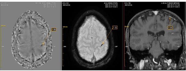 [The figure shows three brain MRI views. The left and middle images are axial susceptibility-weighted MRI sequences, and the right image is a coronal T1-weighted post-contrast image. An arrow labeled ‘A’ marks an elongated focus in the region of the left central sulcus, described as hemosiderin microdeposition with microcalcification, best visualized on the SWAN calcium filter image. The same finding is not clearly visible on the other MRI sequences. An arrow labeled ‘B’ indicates the nearby Trolard vein, which follows its usual course and shows no visible abnormality. There are no visible perifocal cortical changes suggesting cytotoxic edema or encephalomalacia.]
