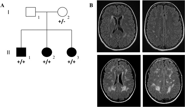 [Figure 1. Family pedigree and brain neuroimaging findings. The illustration consists of two panels: A and B. Panel A shows the family pedigree. In the first generation, two parents are depicted: the male is represented with a square and the female with a circle. In the second generation, their three children are shown: one boy and two girls. All three children are indicated by filled black symbols, denoting that they are affected by Gordon–Holmes syndrome. The RNF216 genotype +/+ is indicated for all three children, representing the homozygous c.1055T>G variant. Mother is marked as a heterozygous carrier of this variant, with the genotype indicated as +/−. Panel B presents brain magnetic resonance imaging findings of the affected family members, acquired in the axial T2-FLAIR sequence. The upper row shows brain images of patient II.2 at 17 years of age, whereas the lower row shows images of patient II.3 at 22 years of age. Multiple foci of hypomyelination are visible in the cerebral white matter of both patients. The white matter abnormalities are more pronounced and more extensive in the images presented in the lower row than in those shown in the upper row.]

