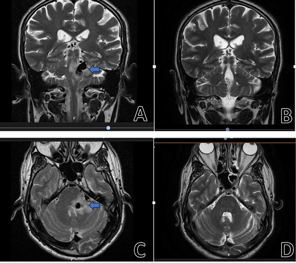[In this picture, there is a MRI sequence, presenting a lesion, which is highlighted by an arrow on both the upper and the lower pictures on the left. On the right-hand side, the postoperative MRI is displayed, showing no residual lesion.]
