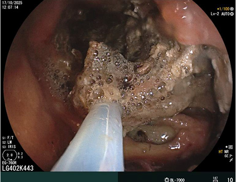 [The stage of removal of pancreatic sequestration with a white endoscopic loop is depicted. The pink gastric mucosa is visible at the edges of the photograph. In the center, black necrotic masses are visible].
