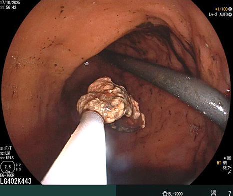 [The lumen of the stomach is shown, which is pink in color. In the right half of the photo, a fistula between the stomach and the omental with a ‘pig-tail-type’ drainage is present. In the left half of the photo, an endoscopic loop with the moment of removal of the sequestrum into the lumen of the stomach].
