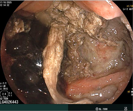 [Through the opening between the stomach and the omental sac, in the center of the photograph, there is the pancreatic tissue, which is pink in color with areas of viability. On the periphery of the photograph, there are partial areas of pancreatic necrosis, dark brown in color].
