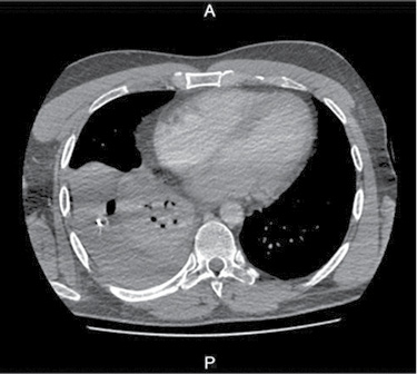 pleura-7.jpg