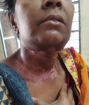 A woman with a scar on her neck.

Description generated by AI