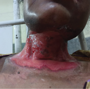 A woman with a red and pink sore on her neck.

Description generated by AI