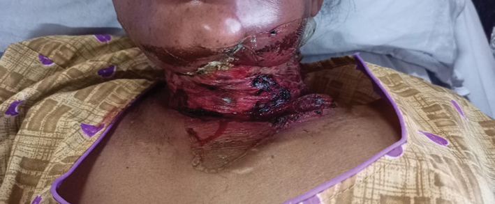 A person with a red and black burn on their neck.
Description generated by AI