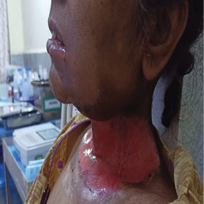 A woman with a red burn on her neck.

Description generated by AI