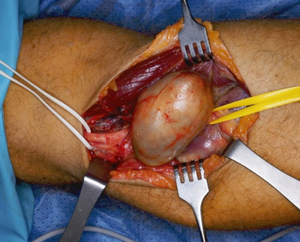 A person's leg with a surgical procedure being performed.
Description generated by AI