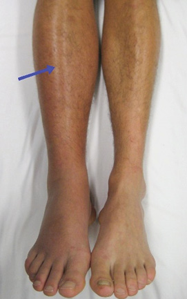 A man's feet with a blue line pointing to the right leg.

Description generated by AI