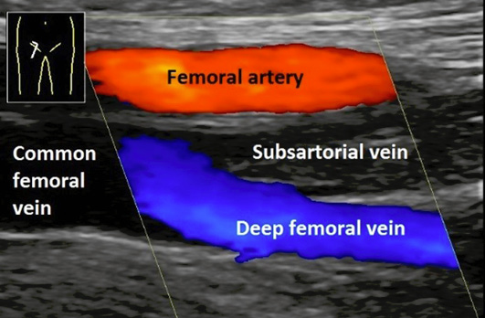A graphic showing the deep and superficial veins.

Description generated by AI
