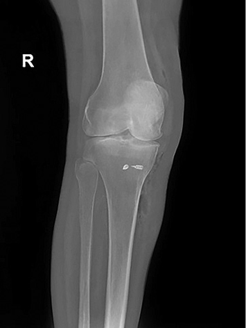 A leg with a knee injury.

Description generated by AI