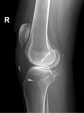 A leg with a broken knee cap.

Description generated by AI