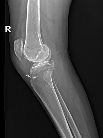 A leg with a broken bone.

Description generated by AI
