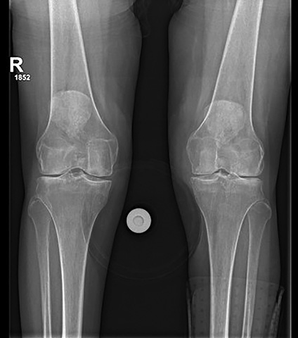 A knee with a metal screw in it.

Description generated by AI