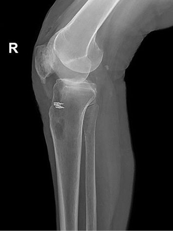 A leg with a metal pin in it.

Description generated by AI