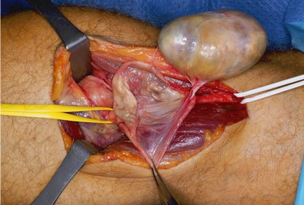 A person's leg with a surgical procedure being performed.

Description generated by AI