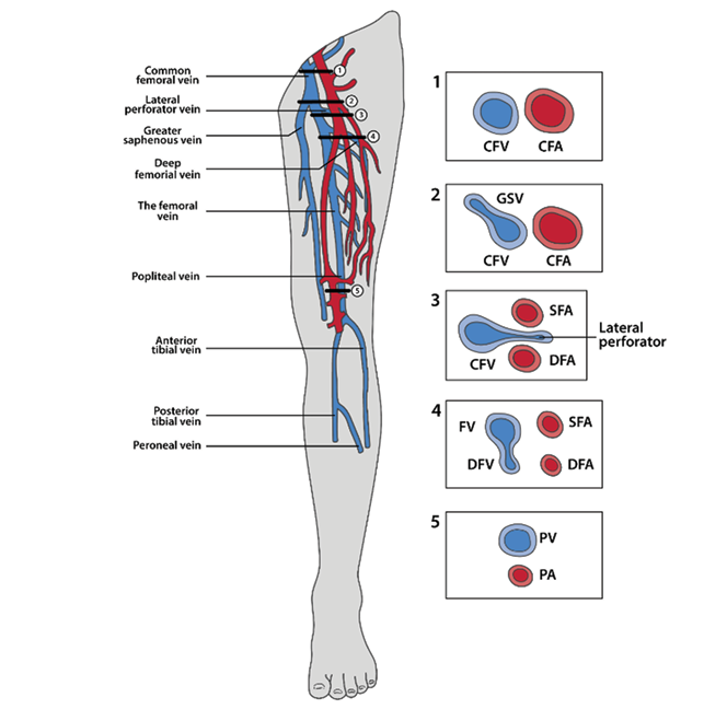 A diagram of a leg with a red vein and blue arteries.

Description generated by AI